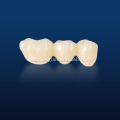 Customized Multilayered Zirconia for Dental Restoration